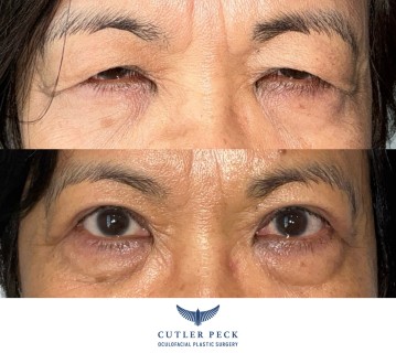 Asian Upper Eyelid Blepharoplasty