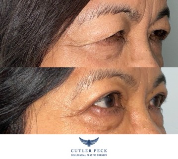 Asian Upper Eyelid Blepharoplasty