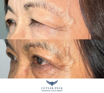 Asian Upper Eyelid Blepharoplasty