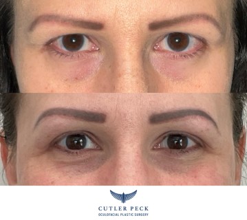 Brow Lift