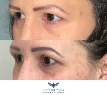 Brow Lift