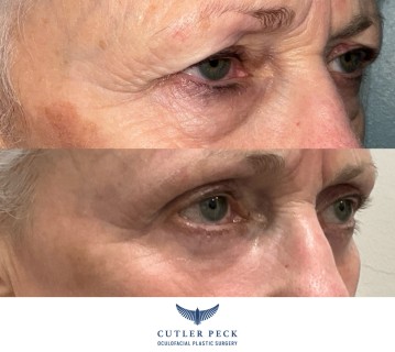 Female Bilateral LOWER Eyelid Blepharoplasty