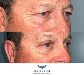 Male Bilateral Upper Eyelid Blepharoplasty