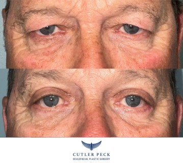 Male Bilateral Upper Eyelid Blepharoplasty