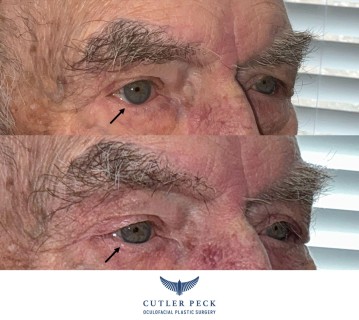 Ectropion Repair Lower Eyelids