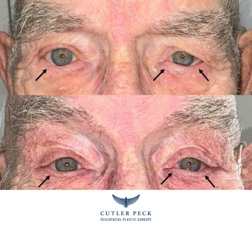 Ectropion Repair Lower Eyelids