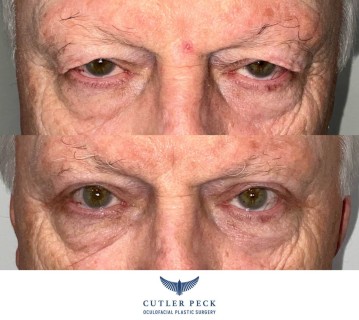 Upper Eyelid Ptosis Repair