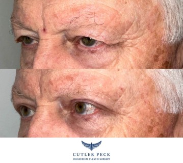 Upper Eyelid Ptosis Repair