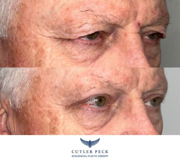 Upper Eyelid Ptosis Repair