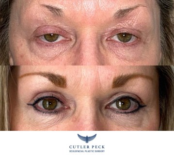 Upper Eyelid Ptosis Repair