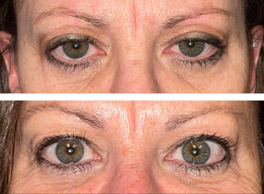 60-year-old female 2 and ½ weeks after an internal ptosis of both upper eyelids. The ptosis improved with Phenylephrine drops placed in each eye in the clinic prior to surgery. Because her eyelids elevated with the Phenylephrine, the surgery was performed from the side of her eyelid closest to her eye. This is a great approach to ptosis repair as the outcome is very predictable, with minimal swelling or bruising and a quick heling time after surgery. She can see better too!!!!