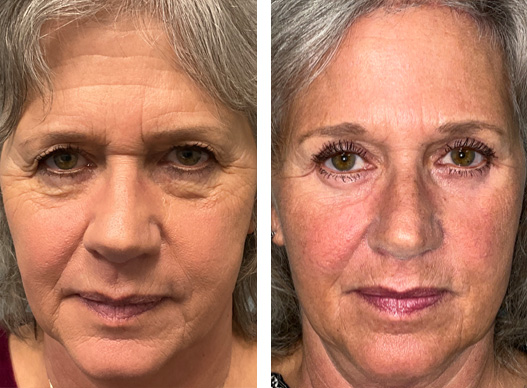 transfollicular brow lift before and after