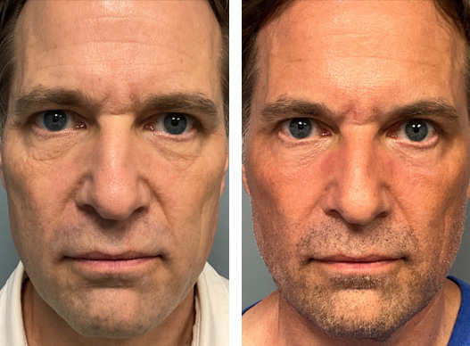 ultraclear overall facial rejuvenation before and after