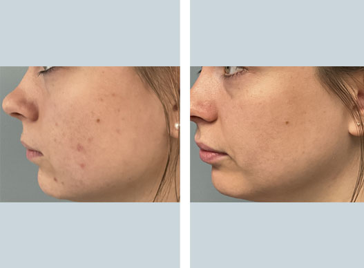 ultraclear full face rejuvenation before and after