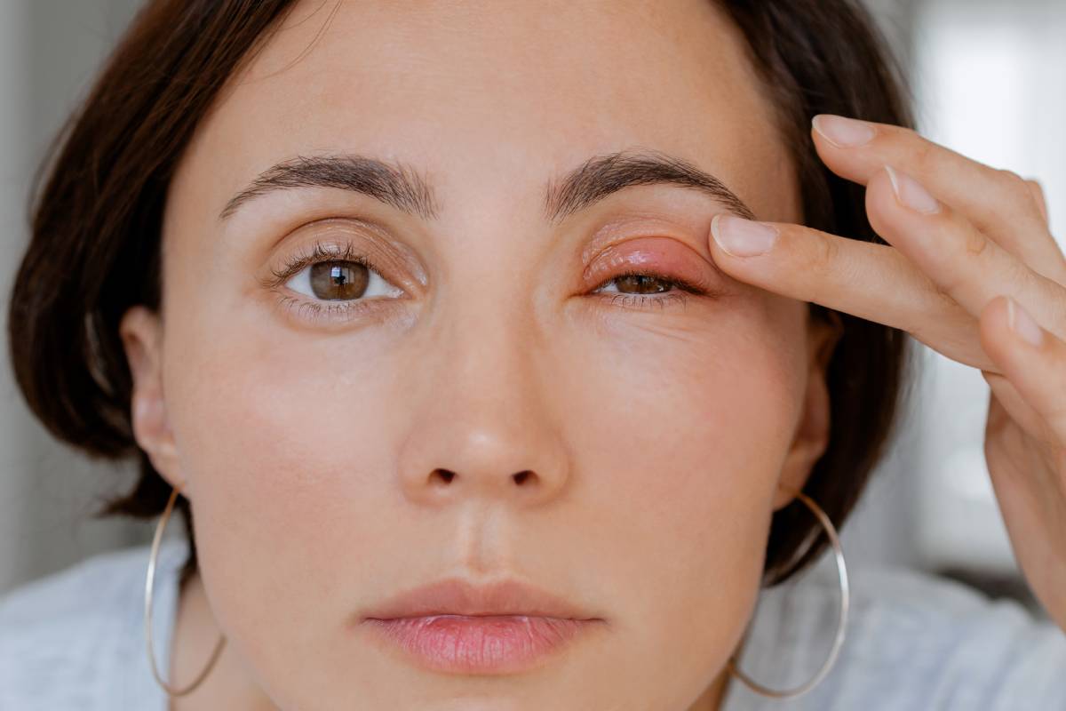 Close up female patient's swollen eye.