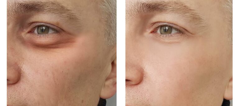 The image shows the before and after of a man who underwent blepharoplasty and displays what makes a male eyelid attractive.