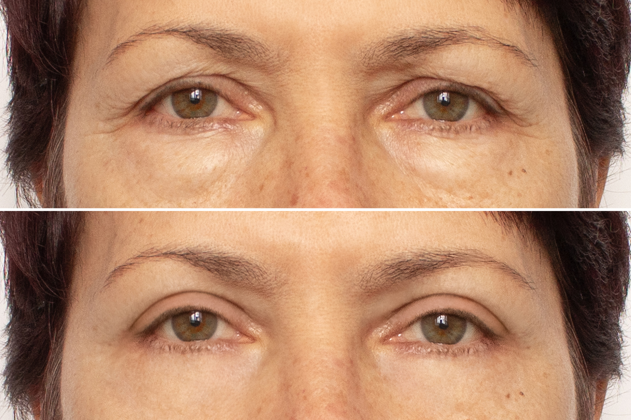 Featured image for "Most Common Reasons for Eyelid Surgery"