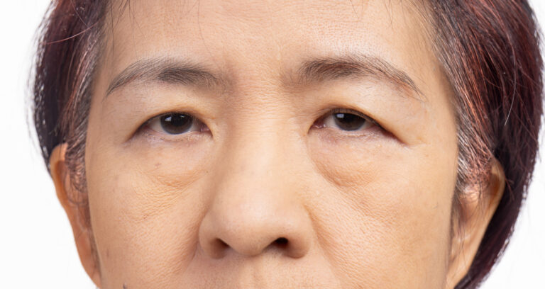 Featured image for The Effects of Droopy Eyelids on Confidence and Perception