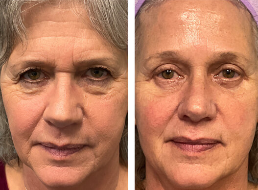 transfollicular brow lift before and after