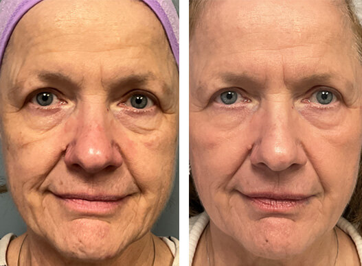 ultraclear full face rejuvenation before and after