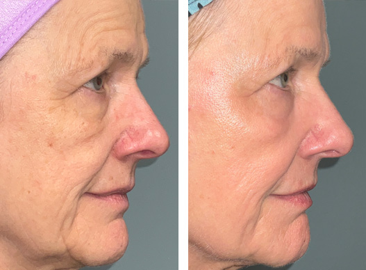 This beautiful 66-year-old woman is absolutely thrilled with the outcome of her UltraClear Laser treatment. She has had 2 treatments in 5 months with this revolutionary technology. She feels much more confident as she prepares for her daughter’s wedding coming up in a month. She wears less makeup (the photos are taken with NO MAKEUP) and feels younger and more vibrant. She has seen many favorable changes in her skin, including smoother texture, improved color, fewer lines and increased firmness. She states, “The downtime is worth it!! After a few days, you notice an immediate improvement. It’s truly amazing!”