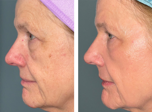 This beautiful 66-year-old woman is absolutely thrilled with the outcome of her UltraClear Laser treatment. She has had 2 treatments in 5 months with this revolutionary technology. She feels much more confident as she prepares for her daughter’s wedding coming up in a month. She wears less makeup (the photos are taken with NO MAKEUP) and feels younger and more vibrant. She has seen many favorable changes in her skin, including smoother texture, improved color, fewer lines and increased firmness. She states, “The downtime is worth it!! After a few days, you notice an immediate improvement. It’s truly amazing!”