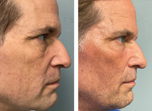 57-year-old male after UltraClear laser treatment. He states, “There is an overall improvement in my appearance. My skin looks smoother and younger, especially my lower eyelids.” The UltraClear laser uses revolutionary technology that allows a highly tailored treatment. The UltraClear can treat superficial pigment as well as fine and deep lines. Patients see a lifting and tightening of their face along with an improvement in the texture and color of their skin.