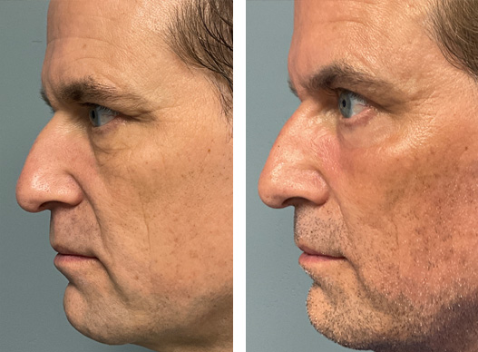 57-year-old male after UltraClear laser treatment. He states, “There is an overall improvement in my appearance. My skin looks smoother and younger, especially my lower eyelids.” The UltraClear laser uses revolutionary technology that allows a highly tailored treatment. The UltraClear can treat superficial pigment as well as fine and deep lines. Patients see a lifting and tightening of their face along with an improvement in the texture and color of their skin.