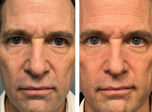 ultraclear overall facial rejuvenation before and after