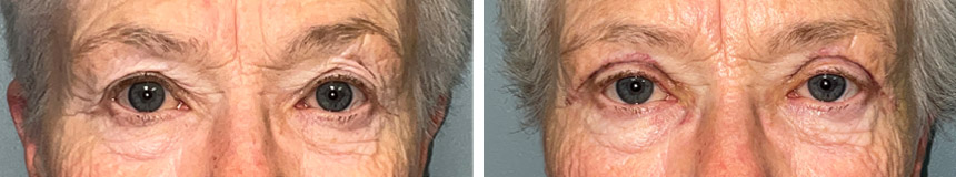 Cosmetic Bilateral Upper Eyelid Blepharoplasty: A 68-year-old female here 13 days after a cosmetic upper eyelid blepharoplasty. She has a very small amount of bruising still visible and is confident out and about in public. She is thrilled with her results and appears refreshed and natural.