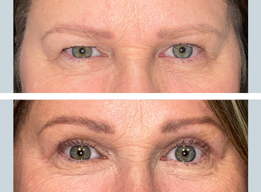 Bilateral Upper Eyelid Blepharoplasty: 54-year-old female is thrilled after undergoing an upper eyelid blepharoplasty. She feels younger and more vibrant. She can wear her makeup as desired once again. She looks refreshed and natural. Others can now see her beautiful eyes as she shares her vibrant love of life with others.