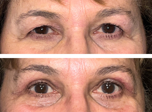 Shown here is a 66-year-old female 9 days after her upper eyelid blepharoplasty. She used Lid-Lift-Goggles which allow rapid healing by decreasing the amount of bruising and swelling in the first days after surgery. The sutures used are dissolvable, but if any amount of suture material is remaining at the post-op visit, it is removed. The incision lines are still visible at this point after surgery, as you can see in the above photos, but they are hidden in a smile line and they fade quickly. She states “It was so incredible to wake up after a day and be able to see without moving my head up! My brother is jealous because he has the same eyelids I had and wants the same surgery! My husband says “It’s nice to see your big brown eyes!””