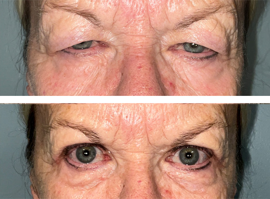 This beautiful 71-year-old female wants everyone to know that this surgery is “Worth it!” She says, “I can see better and I’m so excited to put makeup on again!” She used Lid Lift Goggles which help tremendously with the recovery time by placing gentle compression on the eyelid for the first three days after surgery. When using Lid Lift Goggles, there is minimal bruising and swelling post-operatively.