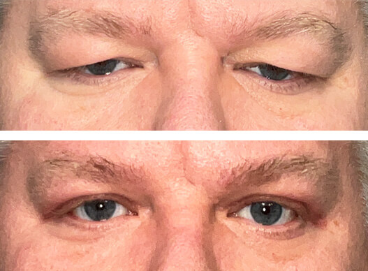 upper eyelid blepharoplasty before and after