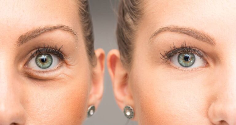 The image shows a female eye with wrinkles and crow's feet before and after cosmetic treatment. The image serves to represent what makes you a good candidate for lower eyelid surgery.